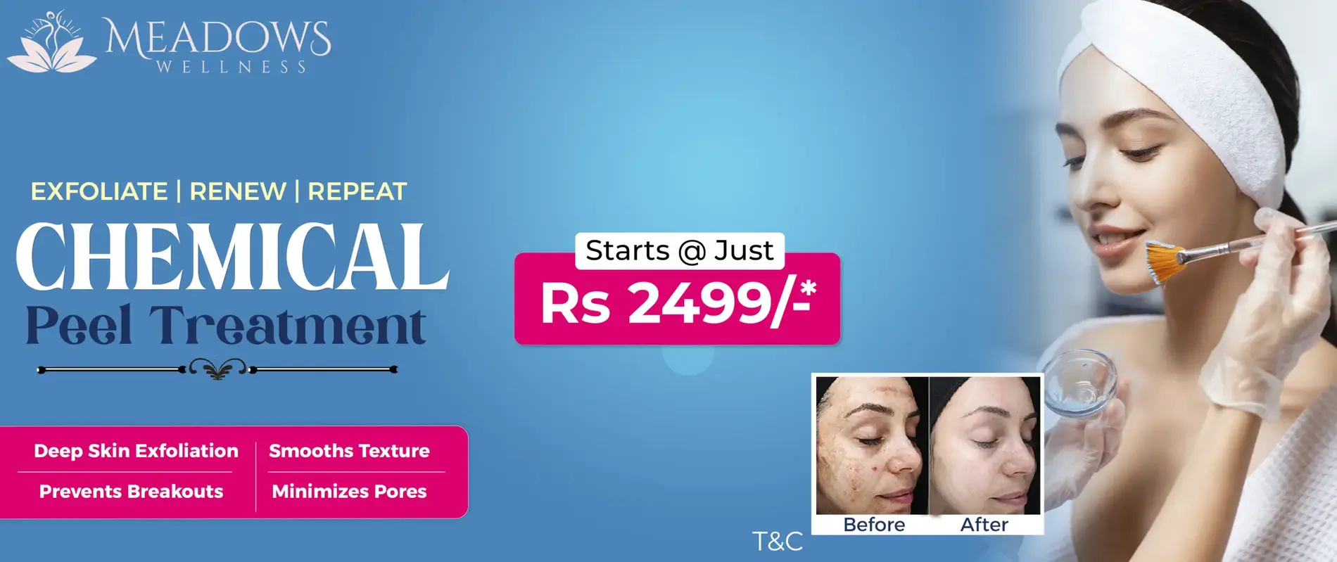 Chemical Peel at 2499